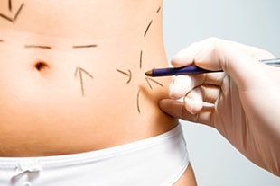 La chirurgie de l’abdomen ou abdominoplastie