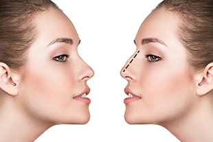 Chirurgie esthétique du nez ou rhinoplastie à Saint-Louis