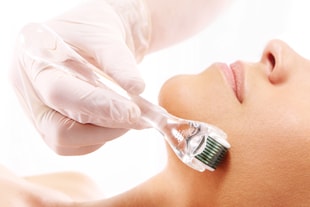 Le micro-needling